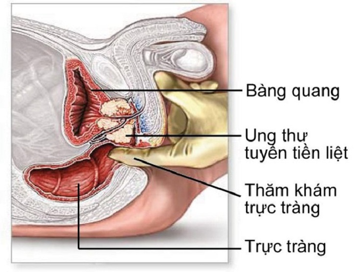 Ung thư tuyến tiền liệt: Triệu chứng và nguyên nhân thường gặp - Ảnh 4.