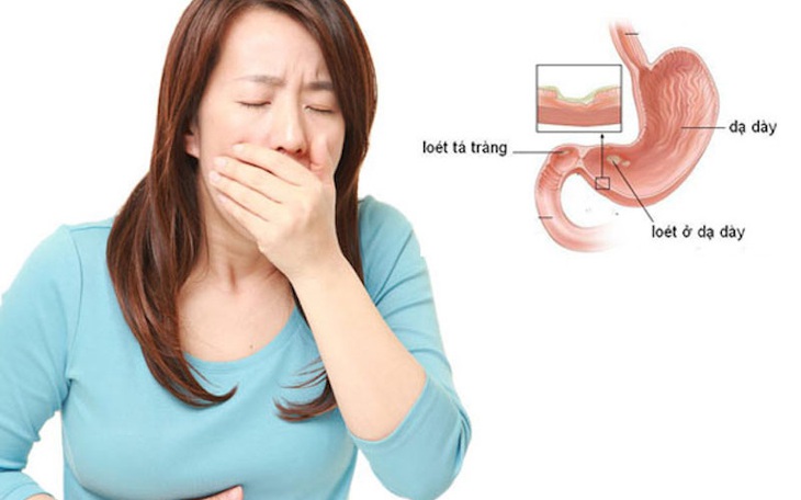 Viêm loét dạ dày - tá tràng: Dấu hiệu, biến chứng nguy hiểm và cách điều trị