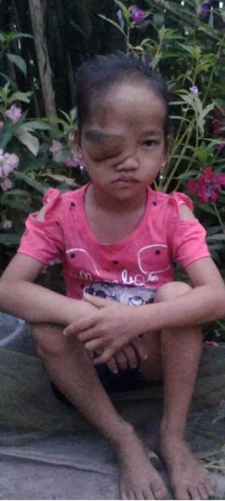 Khối u trên cơ thể ngày một lớn, bé gái dân tộc nghèo mong có tiền để được phẫu thuật sớm - Ảnh 2.