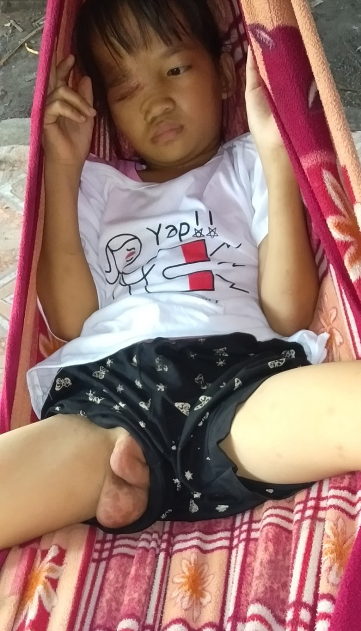 Khối u trên cơ thể ngày một lớn, bé gái dân tộc nghèo mong có tiền để được phẫu thuật sớm - Ảnh 4.