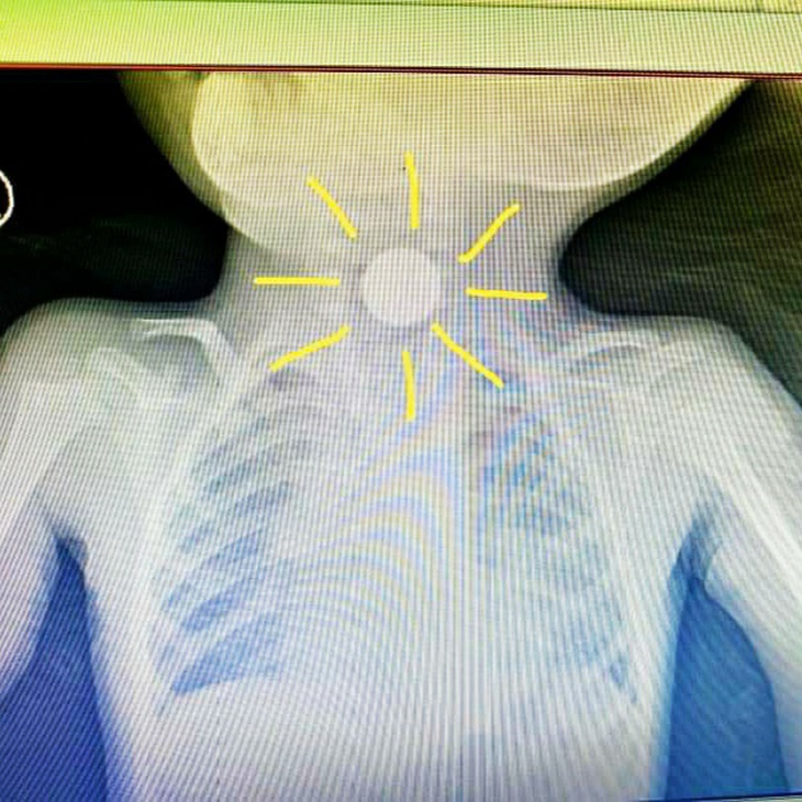 Pin cúc áo, đồng xu đều nguy hiểm khi trẻ nhỏ nuốt phải - Ảnh 4.