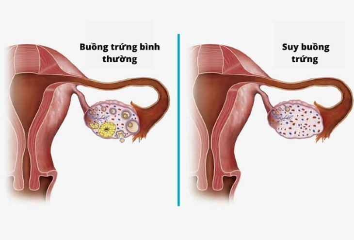 Suy buồng trứng sớm - Các triệu chứng, nguyên nhân và điều trị - Ảnh 1.