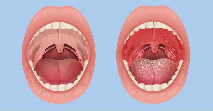 Bệnh viêm họng mạn tính nếu không điều trị tích cực và kiên trì sẽ rất khó khỏi. Bệnh viêm họng mạn tính nếu không điều trị tích cực và kiên trì sẽ rất khó khỏi.