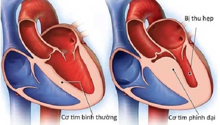 Viêm cơ tim sau tiêm vaccine COVID- 19: Có vì thế mà chúng ta quan ngại không tiêm vaccine ? - Ảnh 3.