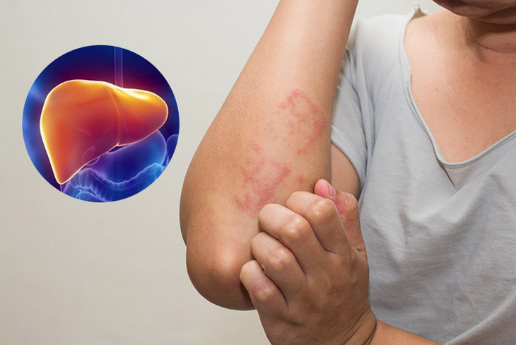 Giải pháp tự nhiên hỗ trợ bảo vệ gan khi dùng thuốc dài ngày - Ảnh 1. Giải pháp tự nhiên hỗ trợ bảo vệ gan khi dùng thuốc dài ngày - Ảnh 1.