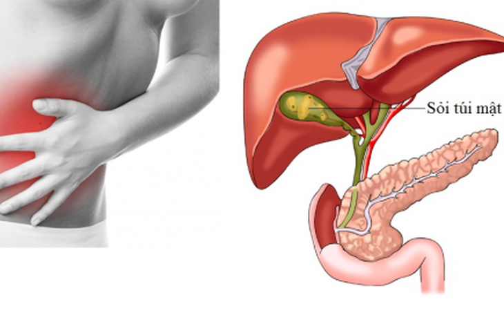 Các biến chứng nguy hiểm của sỏi mật
