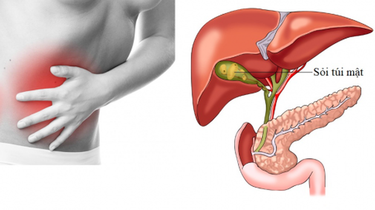 Các biến chứng nguy hiểm của sỏi mật - Ảnh 3. Các biến chứng nguy hiểm của sỏi mật - Ảnh 3.