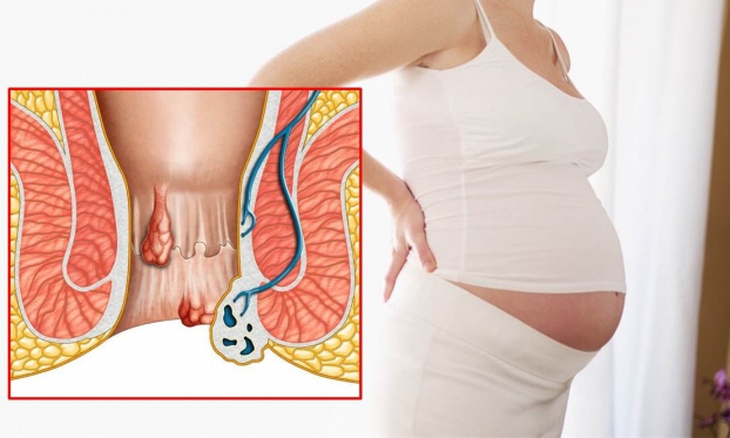 Điều đầu tiên phải khẳng định rằng bệnh trĩ không làm tổn hại sức khỏe của mẹ và em bé.