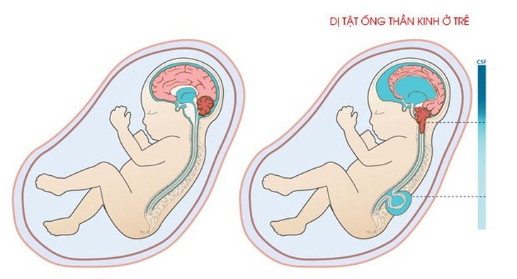 Dinh dưỡng ngăn ngừa dị tật bẩm sinh trong thai kỳ - Ảnh 2.