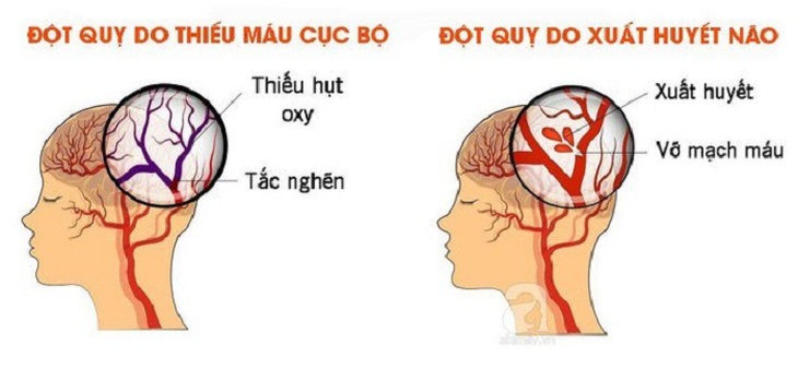 Cách xử trí các ca bệnh đột quỵ cấp liên quan tới COVID-19 - Ảnh 4.