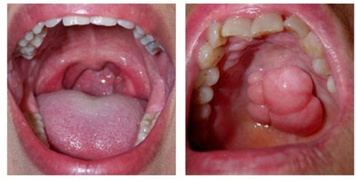 Ngoài thuốc lá, yếu tố nào làm tăng nguy cơ ung thư khoang miệng?- Ảnh 1.
