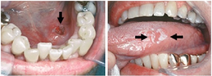 Yếu tố nguy cơ gây ung thư miệng - Ảnh 2.