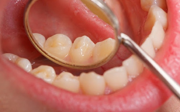 Yếu tố nguy cơ gây ung thư miệng - Ảnh 4.