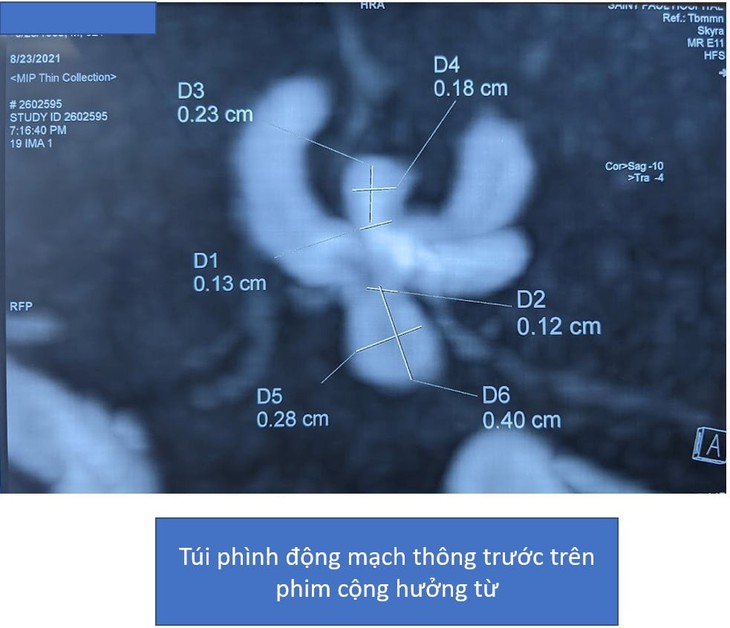 Túi phình động mạch não - "Quả bom" chờ nổ - Ảnh 5.