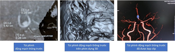 Túi phình động mạch não - "Quả bom" chờ nổ - Ảnh 3.