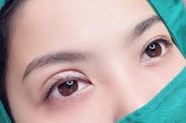 Phẫu thuật cắt mí: Lý do "sốc" khiến ngủ không nhắm mắt - Ảnh 2.