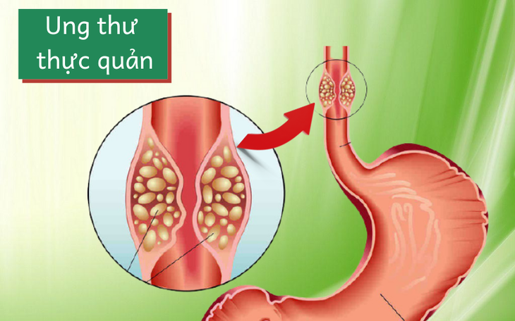  Các biểu hiện của ung thư thực quản 