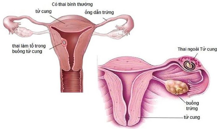 Những nguyên nhân gây đau mỏi vai gáy khi mang thai - Ảnh 2. Những nguyên nhân gây đau mỏi vai gáy khi mang thai - Ảnh 2.