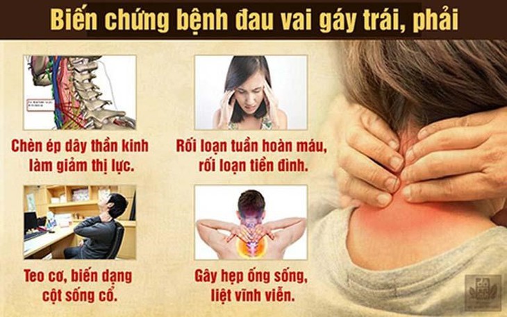 Đau vai gáy là bệnh gì? Nguyên nhân, triệu chứng và cách khắc phục - Ảnh 2.