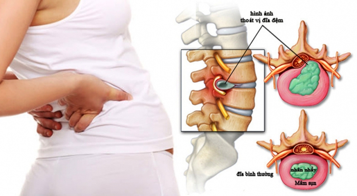 Thoát vị đĩa đệm cột sống, cách điều trị và phòng tránh - Ảnh 1.