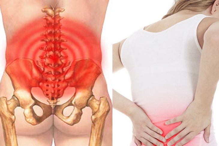 Hội chứng đau thắt lưng: Nguyên nhân, triệu chứng và cách điều trị - Ảnh 3.