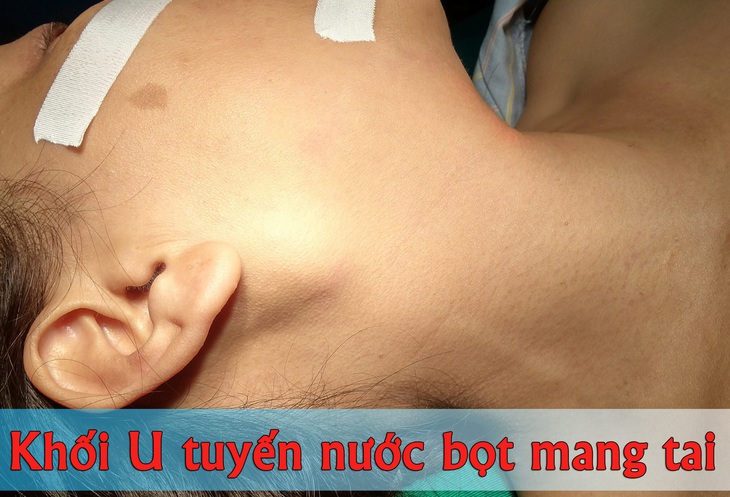 Ung thư tuyến nước bọt: Dấu hiệu nhận biết và các phương pháp điều trị - Ảnh 1.