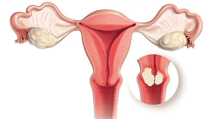 Các triệu chứng thường gặp của  Polyp nội mạc tử cung là ra máu bất thường, đau bụng âm ỉ cùng hạ vị, thiếu máu nếu ra máu kéo dài, nhiều lần.