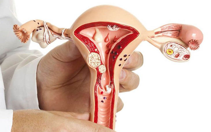Polyp nội mạc tử cung có nguy hiểm không? - Ảnh 3.