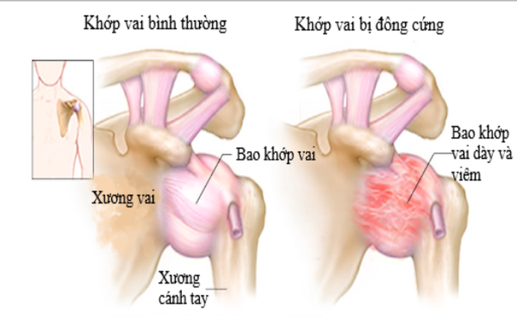 5 bài tập hỗ trợ điều trị viêm quanh khớp vai
