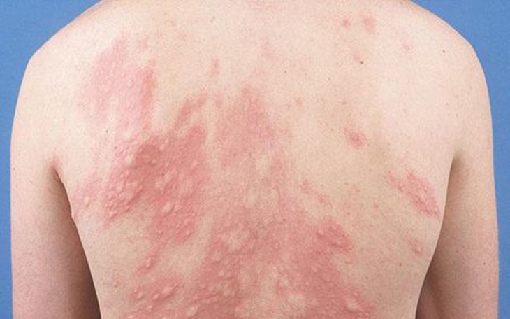 Mề đay là gì, chữa như thế nào? 