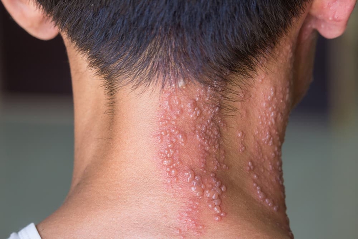 Bệnh zona: Dấu hiệu, triệu chứng và thuốc điều trị - Ảnh 2.