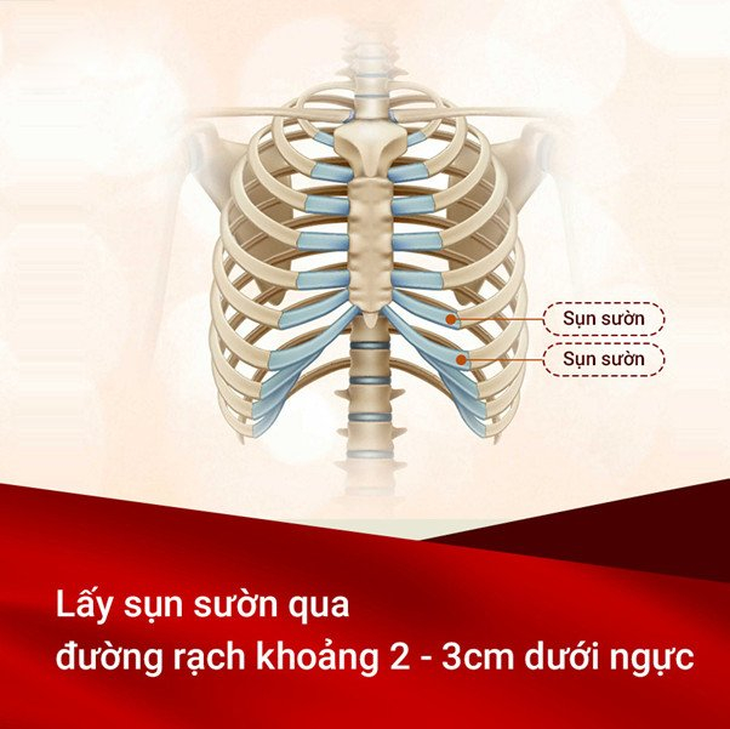 Nâng mũi sụn sườn và những điều bạn cần biết - Ảnh 2.
