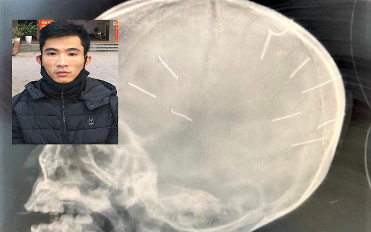 Vụ bé gái 3 tuổi bị ghim đinh vào đầu: Nhiều ngôi sao giải trí đề nghị loại bỏ kẻ ác