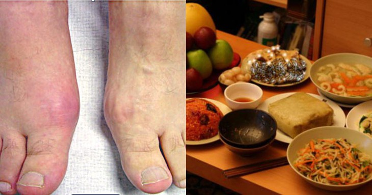 Một số lưu ý đặc biệt cho bệnh nhân gút ngày tết - Ảnh 1. Một số lưu ý đặc biệt cho bệnh nhân gút ngày tết - Ảnh 1.