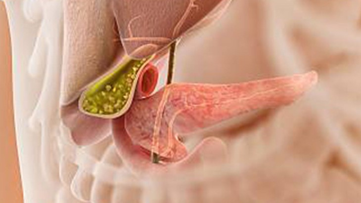 Sỏi mật có thuốc điều trị? - Ảnh 1.
