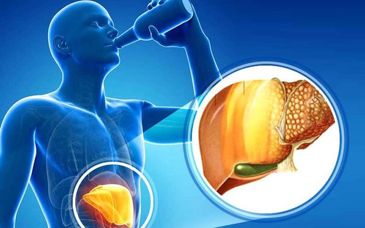Bệnh gan do rượu: Triệu chứng và yếu tố nguy cơ ai cũng cần phải biết