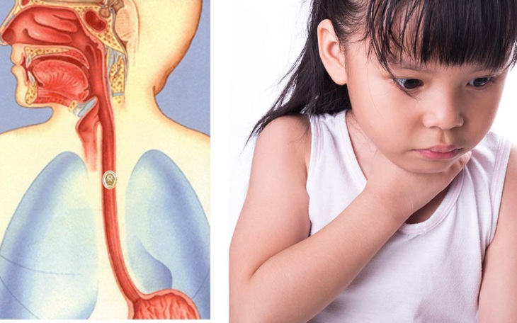 Chuyên gia tai mũi họng cảnh báo thói quen ăn uống dễ gặp dị vật đường ăn 