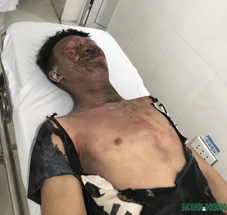 Nam sinh lớp 11 bỏng toàn thân do đốt pháo hoa - Ảnh 1.