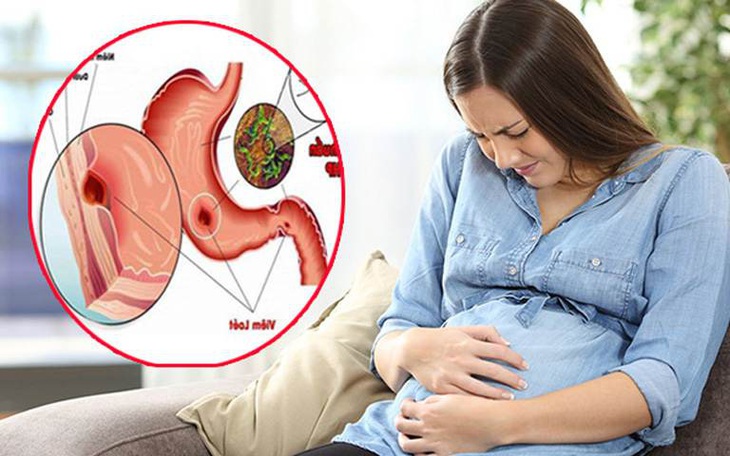 Đau dạ dày khi mang thai, nguyên nhân và cách xử trí 