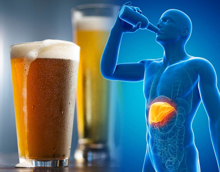 Bệnh gan do rượu: Triệu chứng và yếu tố nguy cơ ai cũng cần phải biết - Ảnh 4. Bệnh gan do rượu: Triệu chứng và yếu tố nguy cơ ai cũng cần phải biết - Ảnh 4.