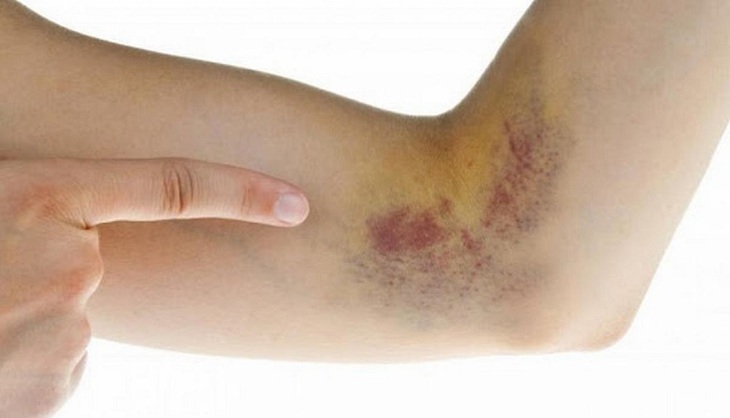 Xanh xao, mệt mỏi, khó thở… cảnh giác với bệnh suy tủy xương - Ảnh 2. Xanh xao, mệt mỏi, khó thở… cảnh giác với bệnh suy tủy xương - Ảnh 2.