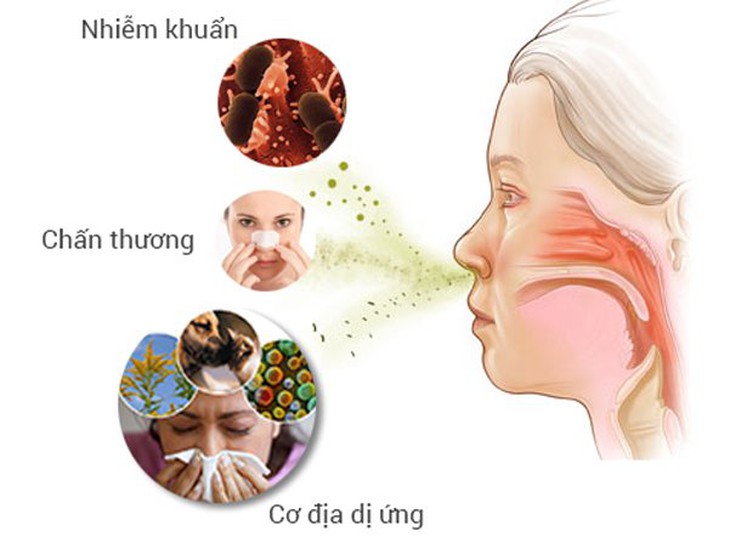 Bệnh viêm mũi dị ứng – Nỗi lo ngày Tết - Ảnh 2.
