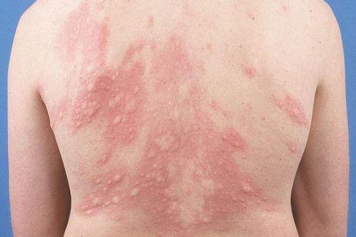Dị ứng thức ăn ngày Tết: Nhận biết và cách xử trí - Ảnh 2.