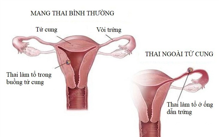 Ảnh hưởng của đau dạ dày khi mang thai - Ảnh 2.