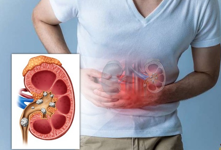 Các yếu tố tăng nguy cơ tạo sỏi thận - Ảnh 2.