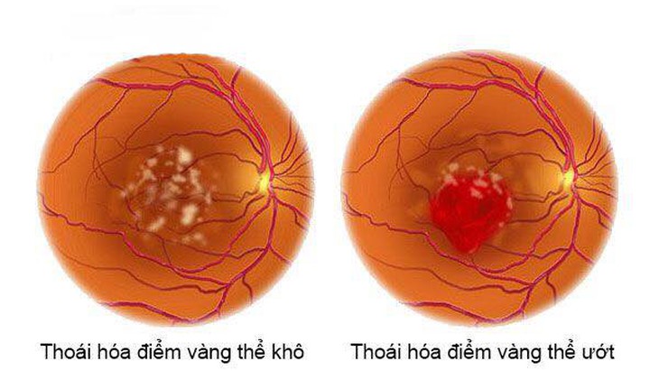 Ngày Tết nói chuyện tác động của rượu bia tới sức khỏe thị giác của bạn - Ảnh 5. Ngày Tết nói chuyện tác động của rượu bia tới sức khỏe thị giác của bạn - Ảnh 5.