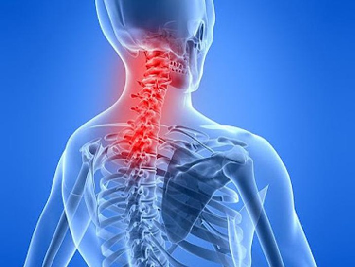 Thoái hóa đốt sống cổ và giải pháp hỗ trợ từ dược liệu tự nhiên - Ảnh 1.