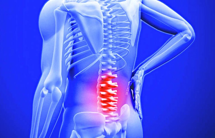 Ung thư di căn cột sống: Triệu chứng, phân loại tổn thương và điều trị - Ảnh 3.