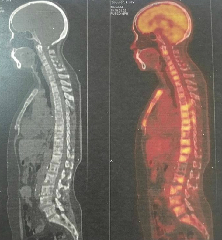 Ung thư di căn cột sống: Triệu chứng, phân loại tổn thương và điều trị - Ảnh 1.