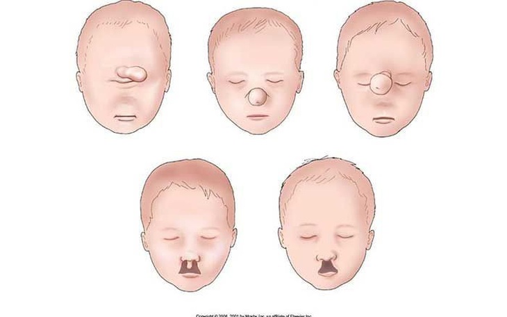 Hôn nhân cận huyết thống: 9 căn bệnh di truyền nguy hiểm mà đứa trẻ sinh ra có thể mắc
